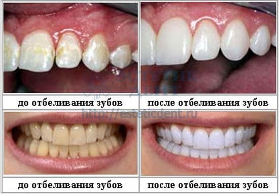 Фотоотбеливание зубов, фото до и после отбеливания зубов ZOOM 3