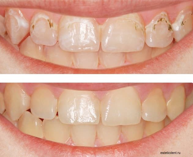Лечение зубов без сверления по системе ICON