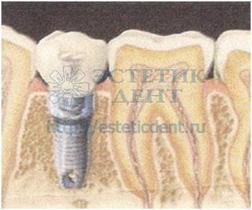 Протезирование зубов и имплантация