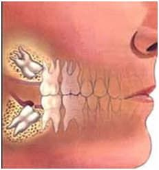 Сложное удаление зубов