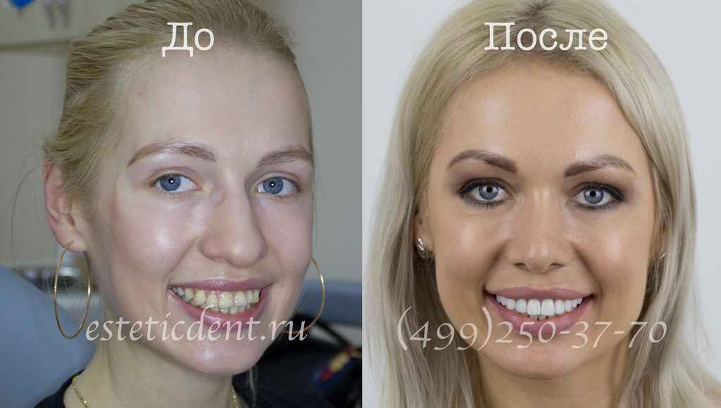 Виниры до и после фото девушек